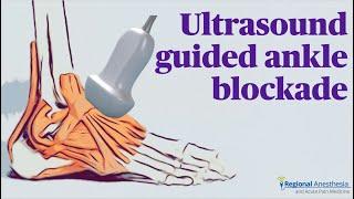 Ultrasound Guided Ankle Block