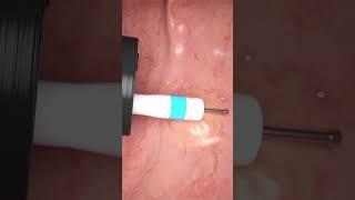 Endoscopic submucosal dissection of colonic polyp