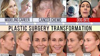 Kristy's Facial Transformation Journey: Uncensored Cuts | Dr. Ben Talei | Beverly Hills CA