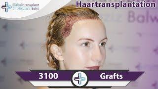 female hair transplant turkey - elithairtransplant istanbul