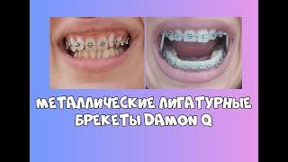 Отзыв металлических лигатурные брекеты Damon Q