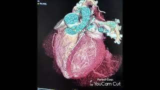 CORONARY VRT.....