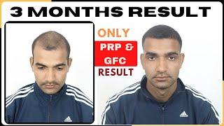 PRP & GFC Result In Case of Hair Loss || 3 Session Result of PRP & GFC