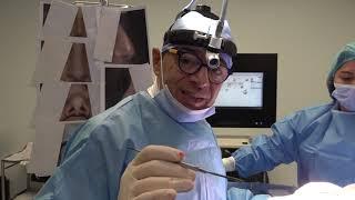 Crooked Nose & Hump-69:Rhinoplasty Bizrah- London/ Dubai-Dr Bashar Bizrah