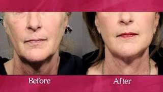 Facelift Procedure Video with Facial Cosmetic Surgeon Dr. Sunder