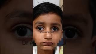 *Squint surgery results by Dr Abhishek Paul*- AB Superspeciality Eye hospital # ll 8815096478