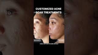 Acne Scar Treatment Results Update 