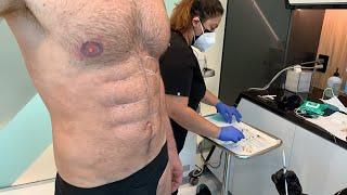 SCULPTING A SIX PACK AFTER GLADIATOR LIPOSUCTION WITH BELLAFILL PERMANENT PMMA | Dr. Jason Emer
