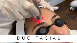 Duo Facial | Radiofrequency Skin Tightening