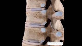 Thoracic Discitis