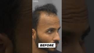 Receding Hairline Transplant Results | Sapphire Hair Transplant Results Before & After