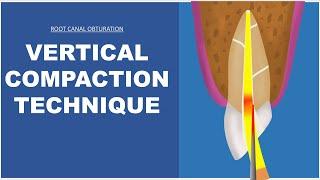 Vertical Compaction Technique | Root Canal Obturation