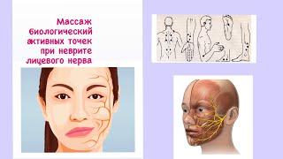 Как лечить неврит лицевого нерва рефлексотерапия точечный массаж.Massage trigger points