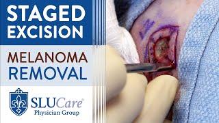 Staged Excision Procedure to Remove Skin Cancer Demonstration - SLUCare Skin Cancer Surgery