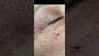 PLASMA LINER
