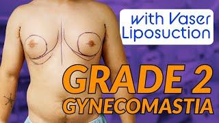 Gynecomastia Grade with Dr Dadvand