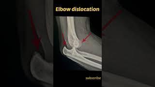 Elbow joint dislocation | Diagnosis Xray | Radiology #radiology #xray #dislocation