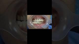 Checking lateral interference with canine tooth for lower anterior dental implant bridge! ##shorts