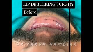 #shorts Lip Reduction Surgery | Dr Varun Nambiar | Celebrity Facial Surgeon