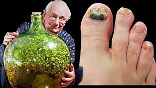 100 Year Old Natural Remedy: Nail Fungus Removal 100% Natural Treatment That Works