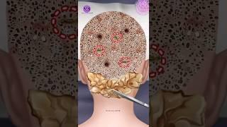 ASMR Giant hardened flakes dandruff removal at hairline | Scalp treatment animation | #asmr #viral