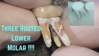3 rooted lower molar