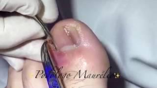 PODOLOGIA SÓ PÉ UNHA ENCRAVADA (INGROWN TOENAIL) - PODÓLOGO MAURÉLIO