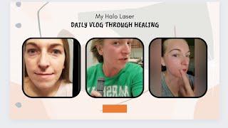 My Halo Laser Treatment: day to day healing + before and after results!