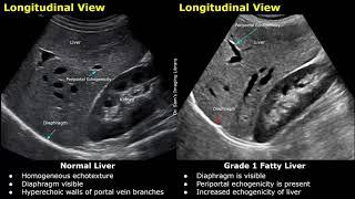 Fatty Liver Grading On Ultrasound | USG Normal Vs Abnormal Images | Grades 1,2 & 3 Hepatic Steatosis