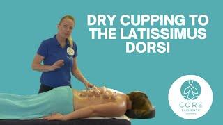 Clinical Dry Cupping to the back - Latissimus Dorsi